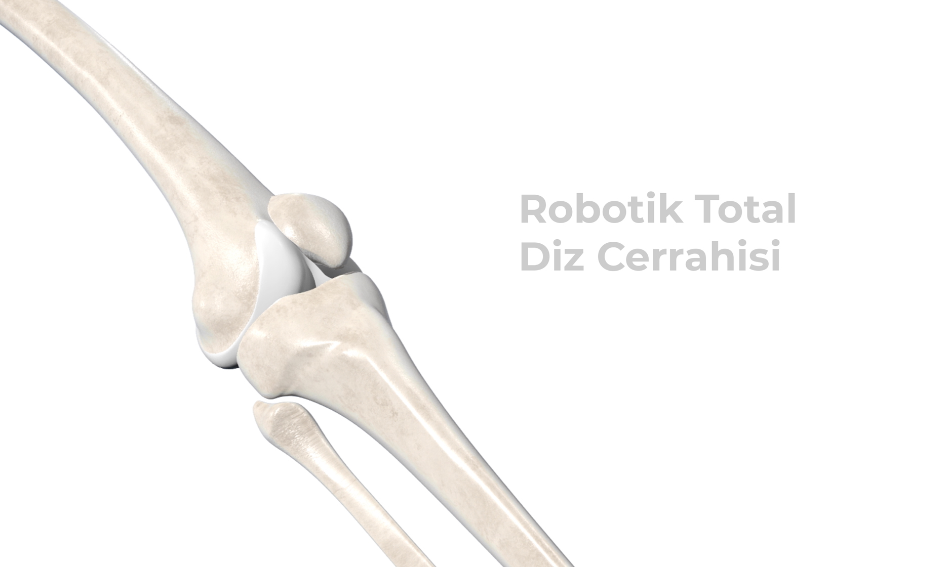 robotik diz cerrahisi