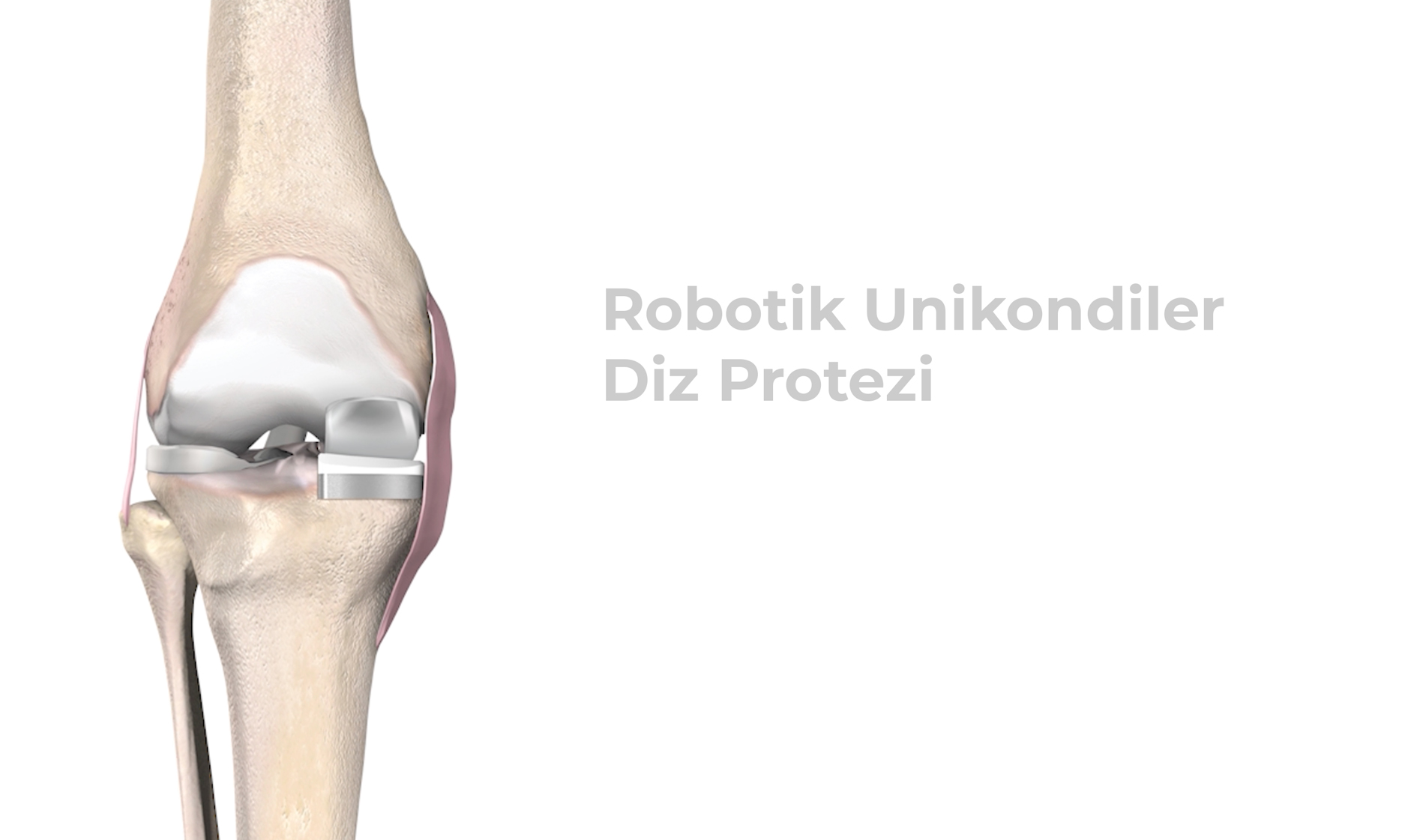 robot unikondiler diz cerrahisi